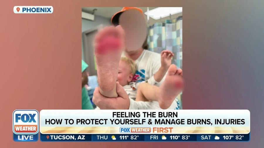 Burn experts warn of injuries from hot surfaces