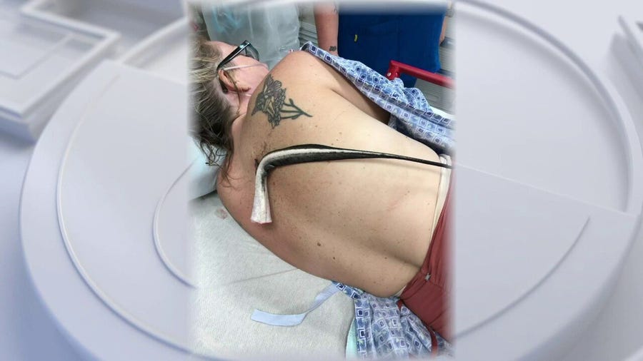 Florida woman survives after impaled by stingray