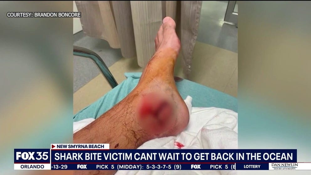 A third surfer was bitten by a shark at a popular beach in Florida and tells FOX 35 in Orlando that even thought he had the unfortunate encounter, he can't wait to get back in the water.