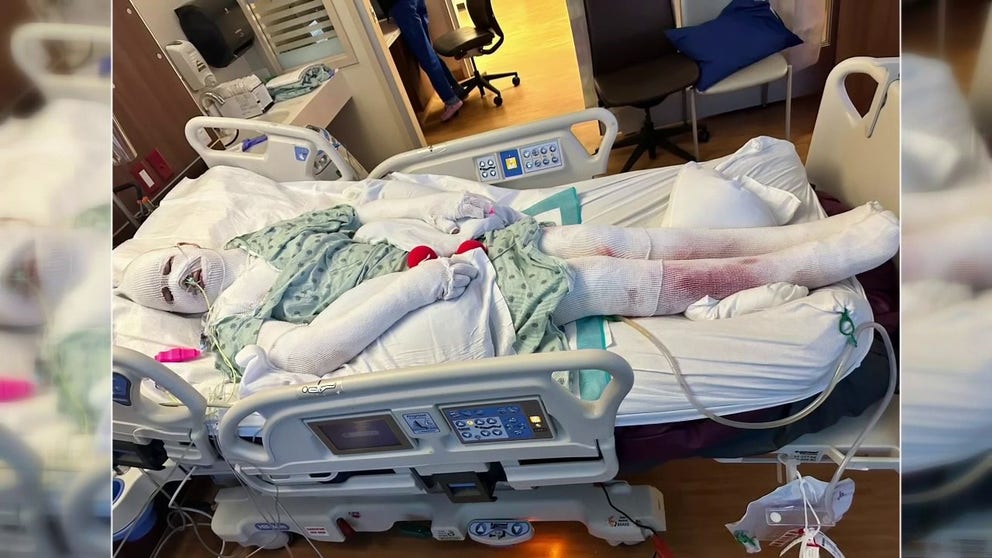 A Houston woman is caring for both her son and mother who suffered severe burns due to downed power lines from the destructive storm on Tuesday and were admitted to intensive care units. FOX 26's Jonathan Mejia reports more on the story after speaking with family.