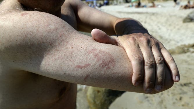 A man shows a jellyfish sting on his arm on a beach in Ajaccio on the French Mediterranean island of Corsica, on June 18, 2022. 