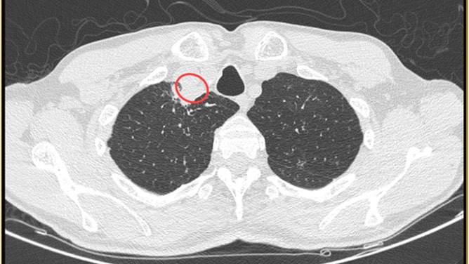 CT scan demonstrated the presence of a right paratracheal abscess.
