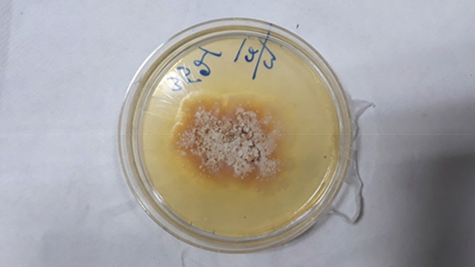 Sabouraud dextrose agar showed growth of creamy pasty colony with buff coloured pigmentation on reverse side after 4–5 days.