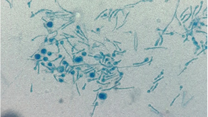 Lactophenol Cotton Blue mount preparation showed round and tubular fungal elements.