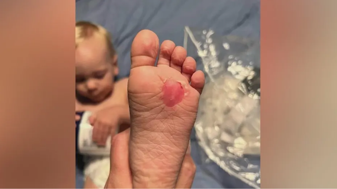 Toddler suffers burns from hot ground