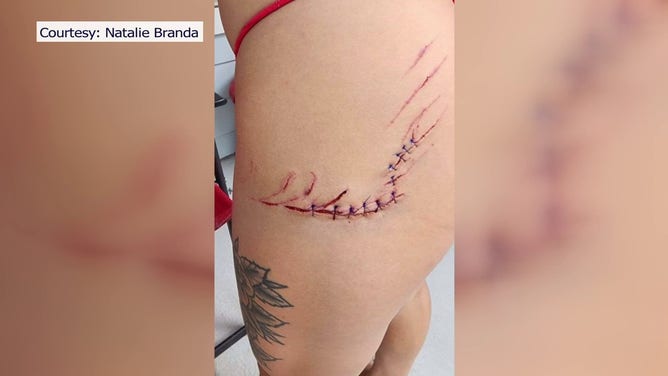 A Florida woman is recovering after a shark bite in St. Petersburg over the weekend.