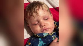 Georgia toddler hospitalized after more than 150 yellowjacket stings