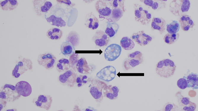 Naegleria fowleri infects people by traveling up the nose and to the brain.